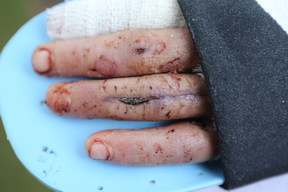 Flesh Eating Disease Leaves Scars On Man's Hand