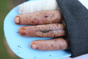 Flesh Eating Disease Leaves Scars On Man's Hand